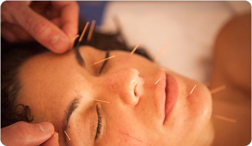 lifting facial con acupuntura fisioetxea alicante fisioterapia, osteopatía y acupuntura